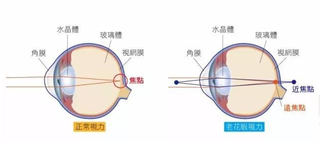 白內(nèi)障和老花眼區(qū)別，老花眼發(fā)病率正呈現(xiàn)年輕化趨勢(shì)